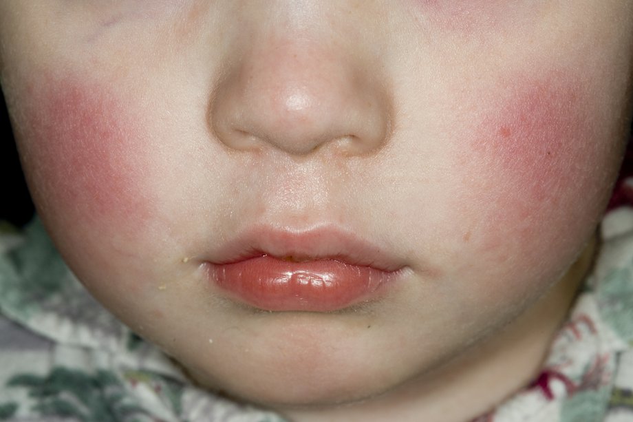 best of Facial rashes Babies