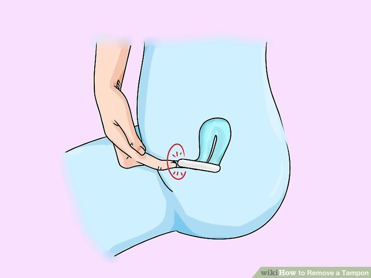 Applicator in lost tampon vagina