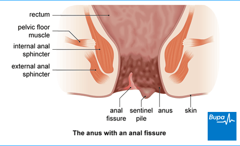 Anal fissure sergery
