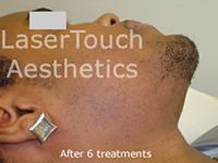 Facial hair removal westchester