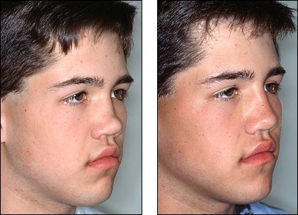 Fourth D. reccomend Facial reconstruction before after photos