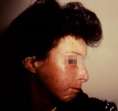 Facial scleroderma pictures
