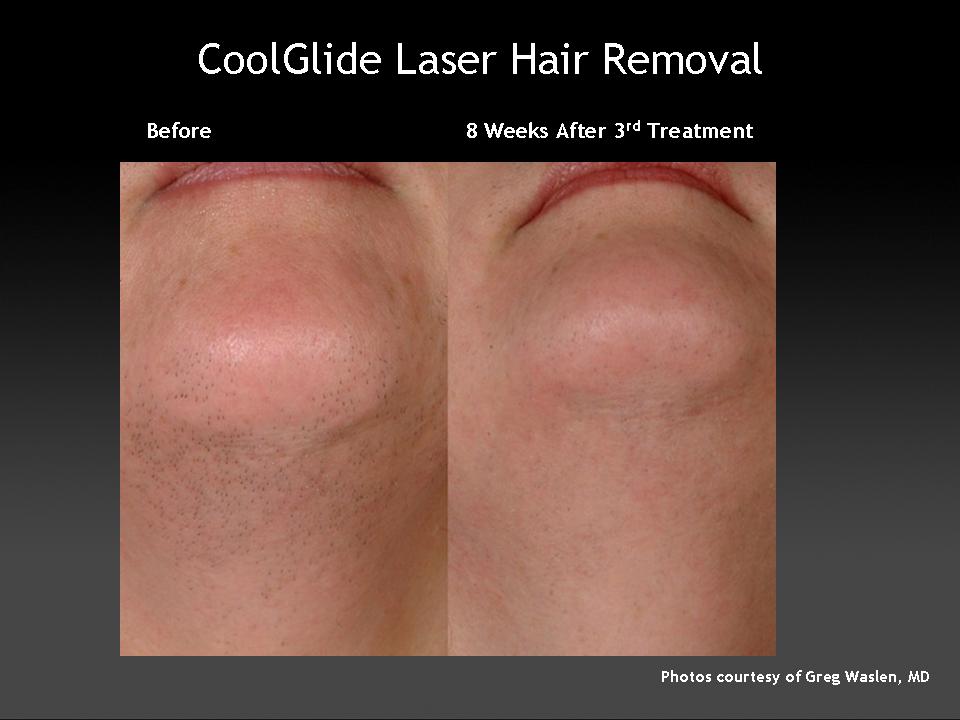 best of Removal Laser facial san antonio hair