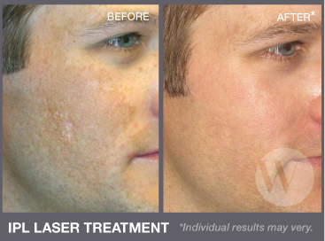 Monster M. reccomend Laser light facial treatments
