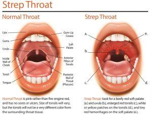 Ezzie reccomend Streph throat in adults