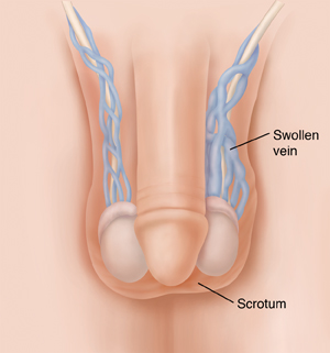 NFL reccomend Verices in scrotum and low sperm count