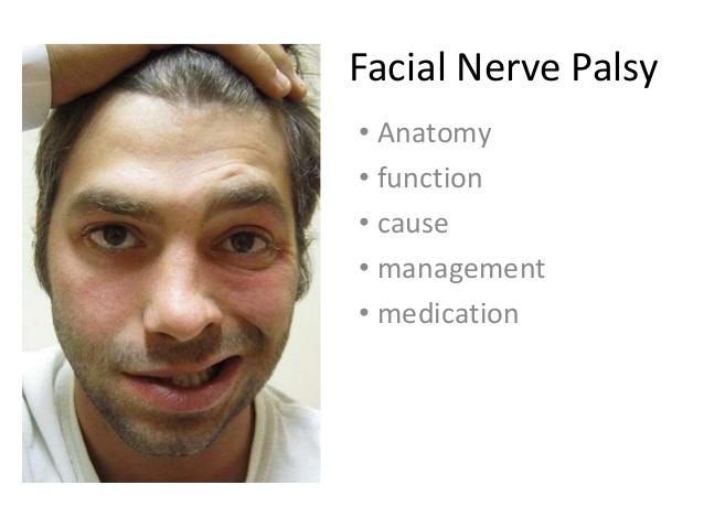 best of Palsy nerve Emedicine facial