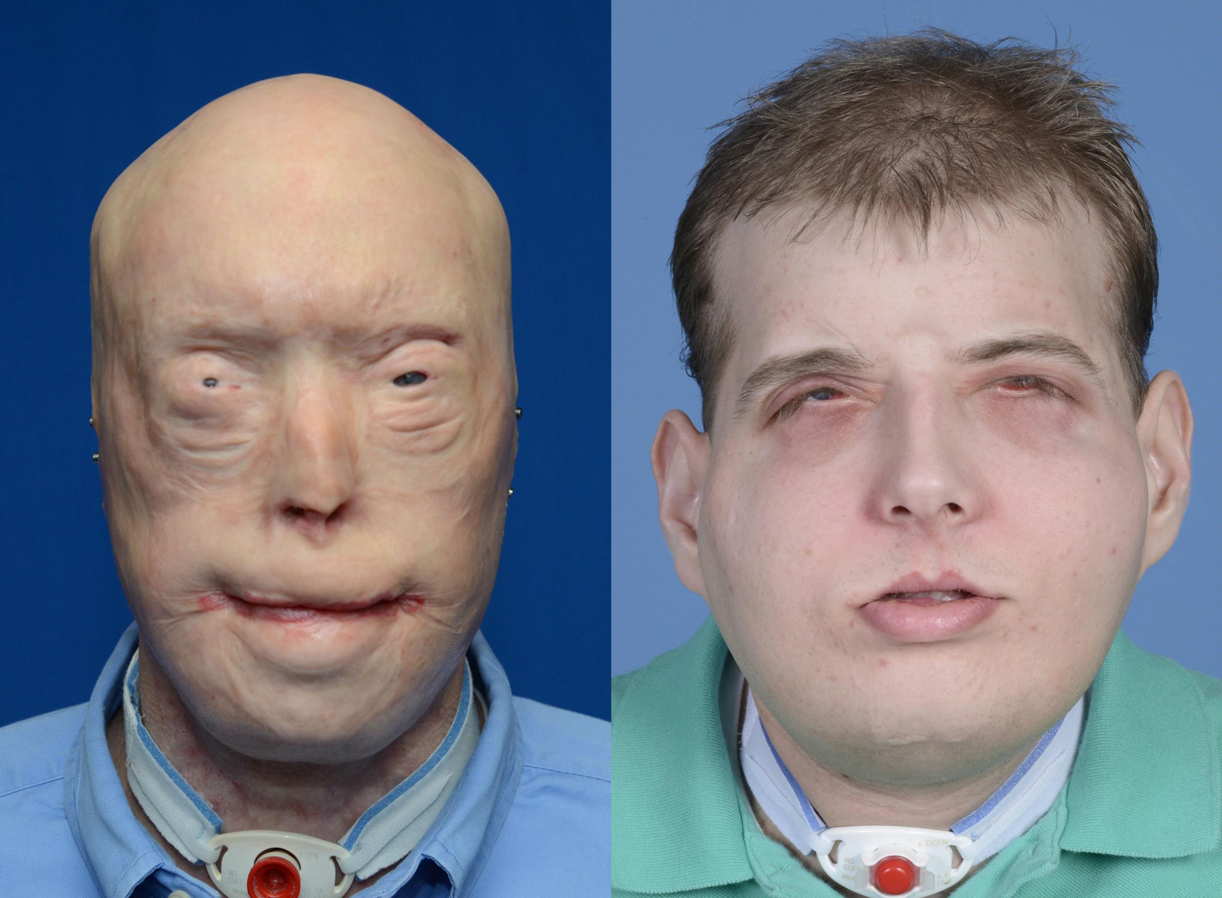 best of Transplant picture Facial first