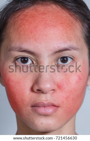 Facial skin irritations