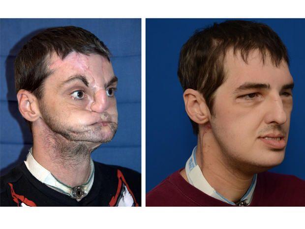 Facial first picture transplant