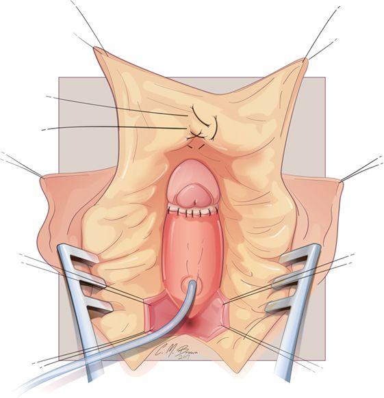 Clitoris enlargement techniques