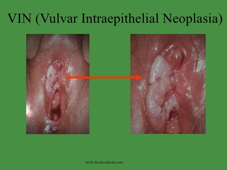 best of Dermatitis vulva of the Pictures of