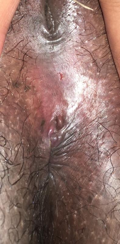 Images of herpes near anus