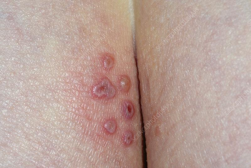 Bomber reccomend Images of herpes near anus