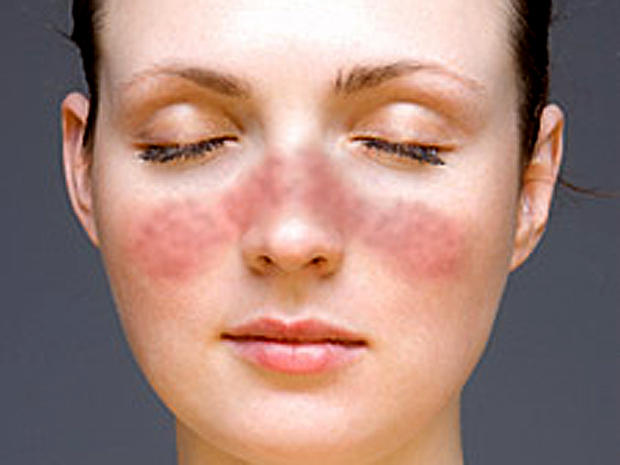 Wind reccomend Facial rash hypothyroidism