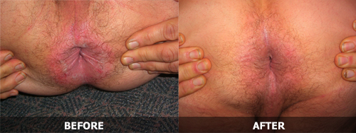 best of Anus Pictures of eczema around
