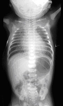 Cannon reccomend Vertebral anal esophageal