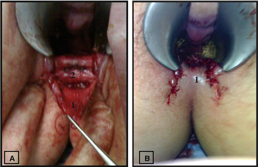 best of Fissure sergery Anal