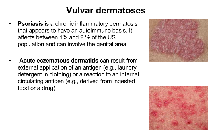 4-Wheel D. reccomend Inflammation disease on vulva