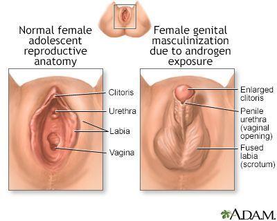 Clitoris enlarged female