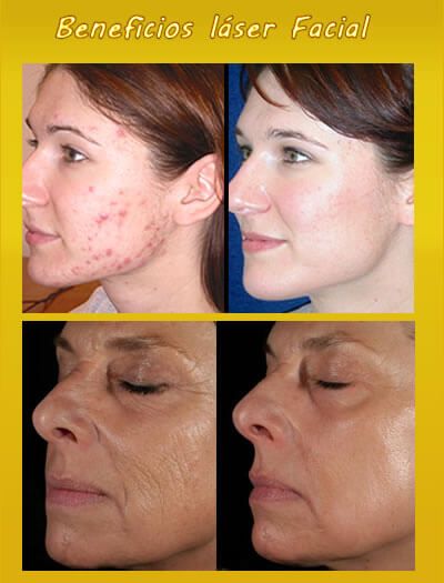 best of Laser Limpieza facial