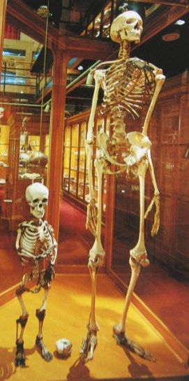 Skeleton of a midget