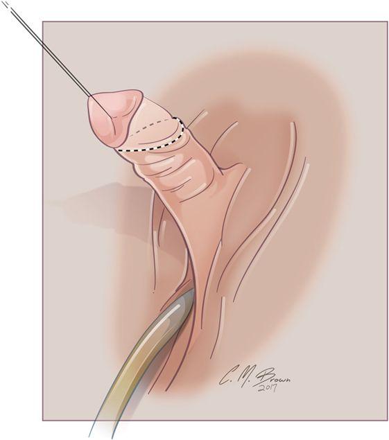 Clitoris enlargement techniques