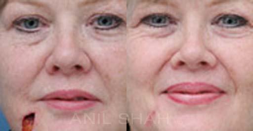 Facial reconstruction before after photos