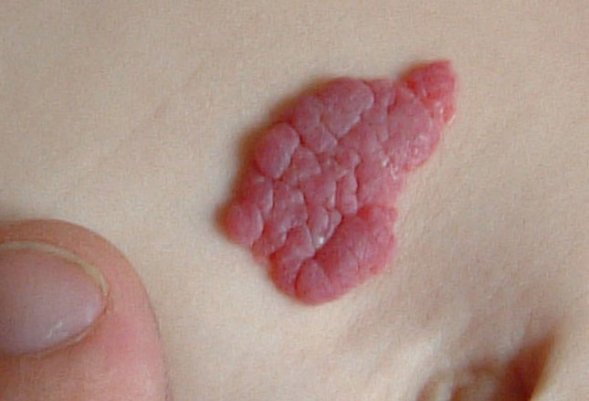Newborn red bumps anus