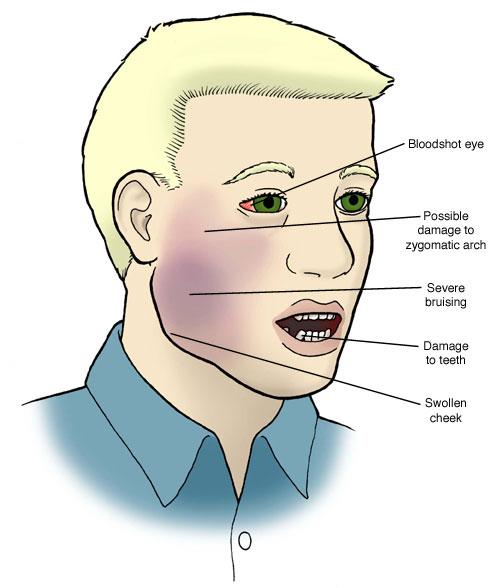 Facial cheek pain