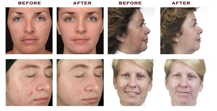 best of Lesions microdermabrasion skin Facial from