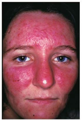 best of Hypothyroidism Facial rash