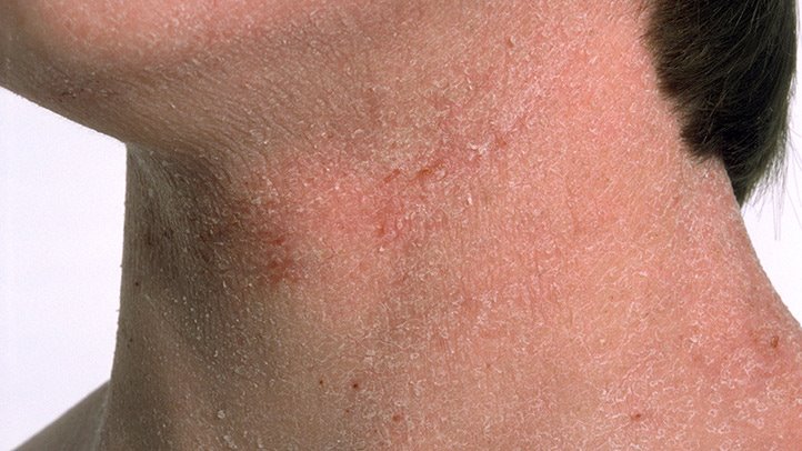 Eclipse reccomend Facial rash hypothyroidism