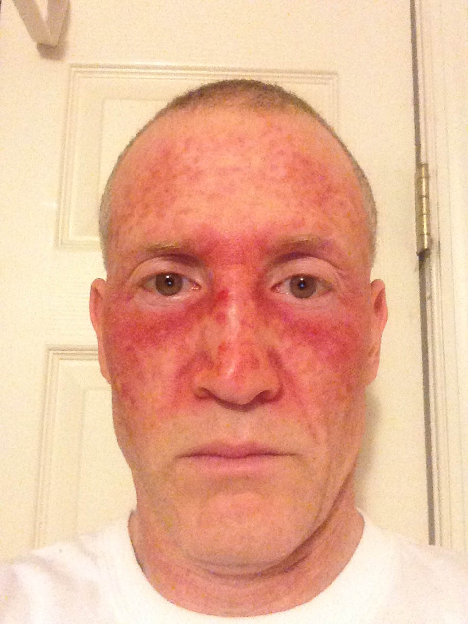 Facial redness skin