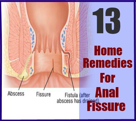 Dollface reccomend Home remedy for anal discomfort