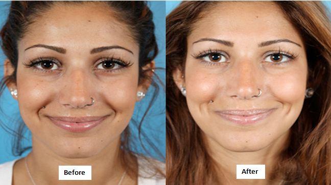 best of Dimple One facial