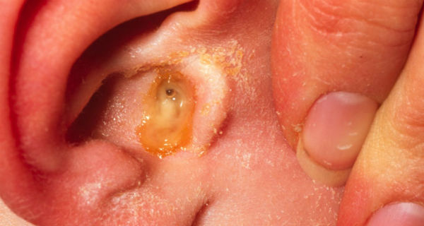 best of In Preventing adults infections ear