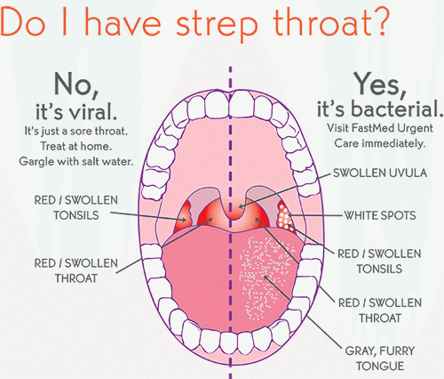 Streph throat in adults
